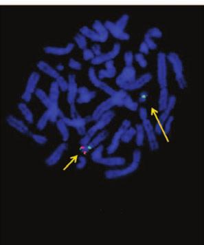 Elżbieta Patkowska i wsp., Wtórna AML w przebiegu fazy przewlekłej CML Rycina 3. Kariogram szpiku kostnego wykonany po chemioterapii indukującej według schematu 3 + 7: 46, XY, t(9;22)(q34;q11.