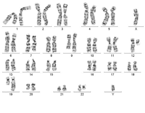 Bone marrow cells karytotype done after induction treatment according to the 3 + 7 regimen: 46, XY, t(9;22)(q34;q11.2) [18]/ 45~46, XY, idem, t(1;5;18), 7, del(12)(p11.