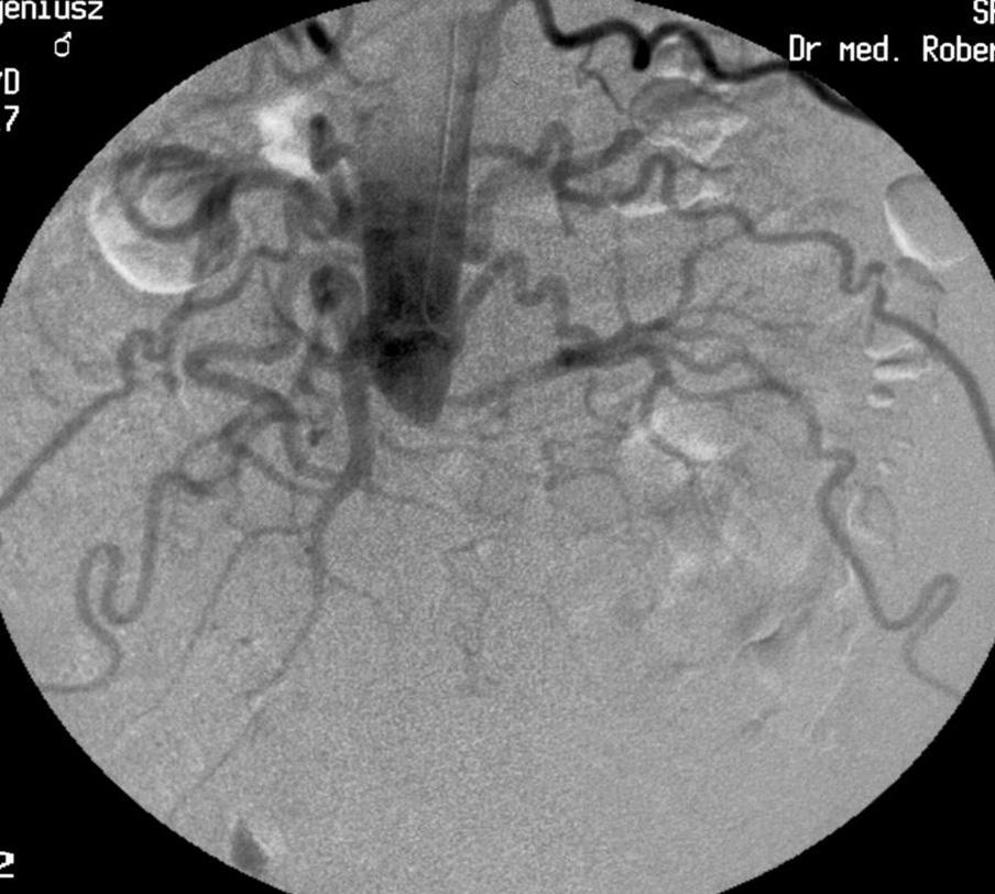 Transbrachial renal artery angioplasty and stenting, Juszkat et al. Figure 1. Patient aged 56. Digital subtraction angiography (DSA) examination performed through left brachial artery access.