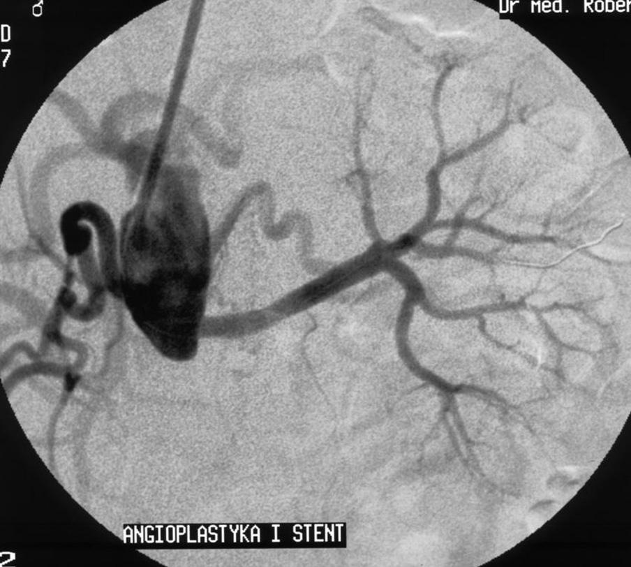 Post angioplasty and stent implantation in left renal artery status Rycina 2. Ten sam chory.