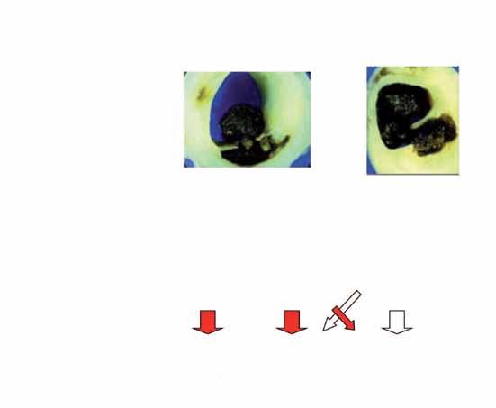 Dławica piersiowa Ostry zespół wieńcowy (OZW) Objawy kliniczne Robocza diagnoza EKG [ OZW bez uniesienia odcinka ST ] OZW z uniesieniem odcinka ST Biomarkery sercowe Końcowa diagnoza Niestabilna