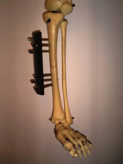 węgiel-węgiel Stabilizatory złamanych