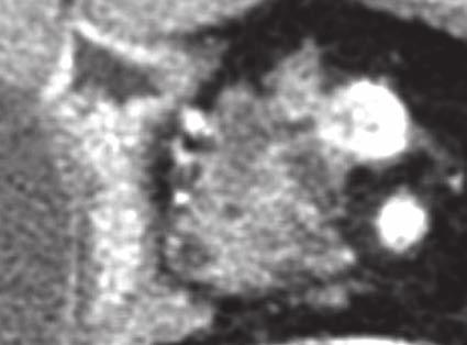 A PŻW (grot strzałki) w obrębie głowy trzustki (P) jest nieco poszerzony do 10 mm.