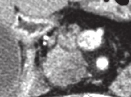 górna. B PŻW (grot strzałki) i przewód trzustkowy (strzałka) zwężają się w wyniku obecności guza w głowie trzustki.
