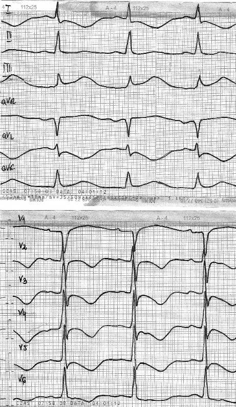 1010 Piotr Kukla et al A B Rycina 3. Typowy torsade de pointes przechodzący w migotanie komór Rycina 4. EKG w 7.