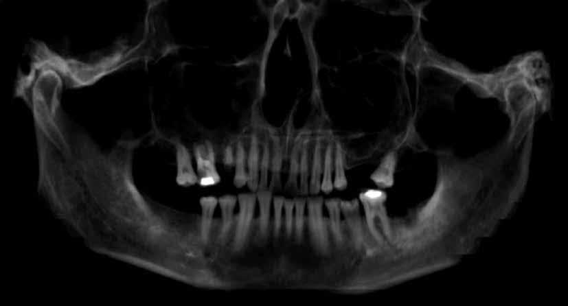 Arch Med Sąd Kryminol 2015; vol. 65: 1 16 Ryc. 4. Rekonstrukcja pantomograficzna z badania TK czaszki przekazanej do badań identyfikacyjnych Fig. 4. Panoramic 3D reconstruction from the CT scan of the skull received for identification procedures ciu en face i prawego profilu.