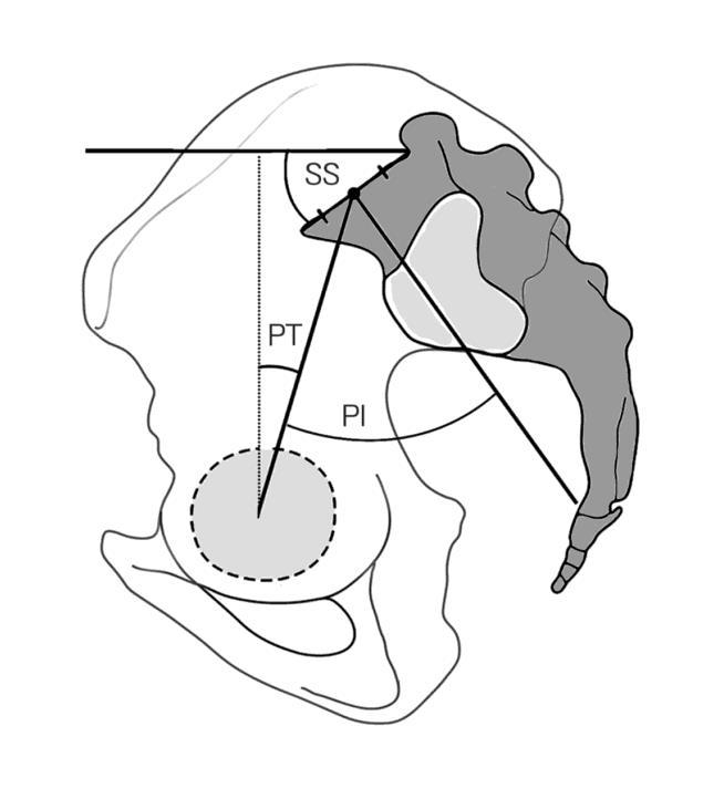 Ryc. 5 Odchylenie miednicy (Pelvic tilt- PT) definiuje się przez kąt utworzony z przecięcia pionowej linii odniesienia, która przechodzi przez środek głowy kości udowej i linii odchodzącej od środka