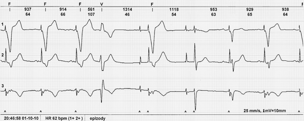 G E R A T R A 2014; 8: 117130 W F P Rycina 4. Zapis elektrokardiograficzny zespołów komorowych zsumowanych w zapisie holterowskim.
