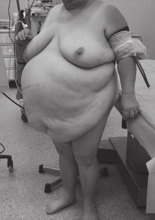 25 22 (78,6%) 20 (71,4%) 20 15 10 6 (21,4%) 8 (28,6%) tak yes nie no 5 0 Powikłania śródoperacyjne Intraoperative complications Powikłania pooperacyjne Postoperative complications Rys. 4.