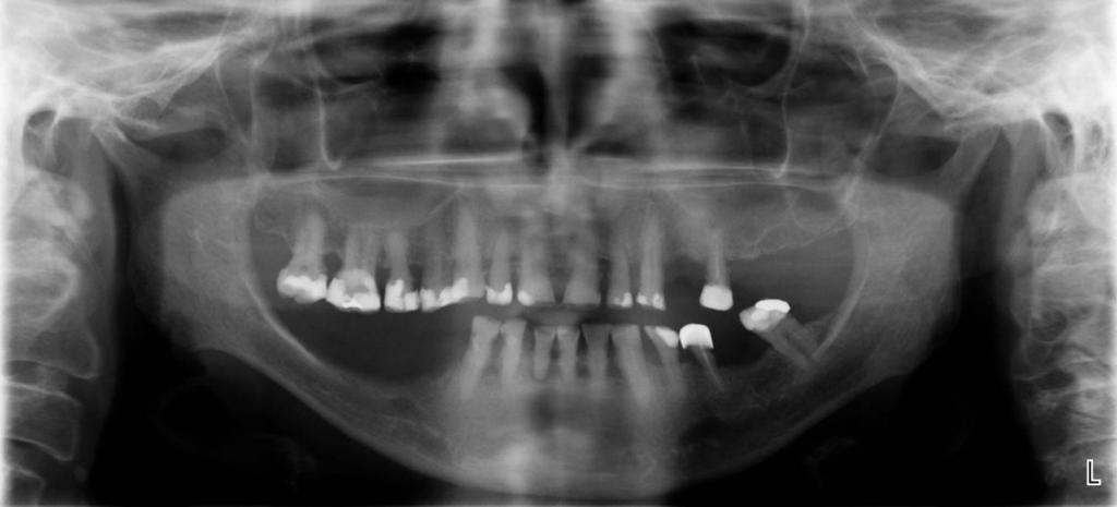 - - - - - J Stoma 2012; 65, 6 Wieczorek A., Loster J., Majewski S. Fig. 2. OPG image of patient qualified to subgroup IIB. Obraz OPG pacjenta zakwalifikowanego do podgrupy IIB.