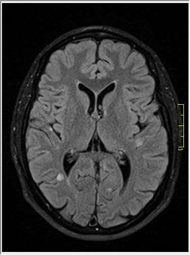 BADANIA NEUROOBRAZOWE W MR mózgu w obrazach T2-zależnych i FLAIR uwidoczniono rozsiane ogniska zlokalizowane