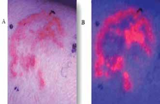 Diagnostyka fotodynamiczna Choroby nowotworowe stanowią jedno z największych zagrożeń współczesnego świata, dlatego oprócz leczenia bardzo ważna jest diagnostyka nowotworowa.