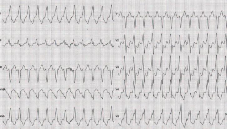 Zapis EKG wykonany podczas próby wysiłkowej widoczny rytm zatokowy, a następnie