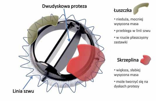przerwanie ciągłości okolicy trójkąta włóknistego przedniego (A)