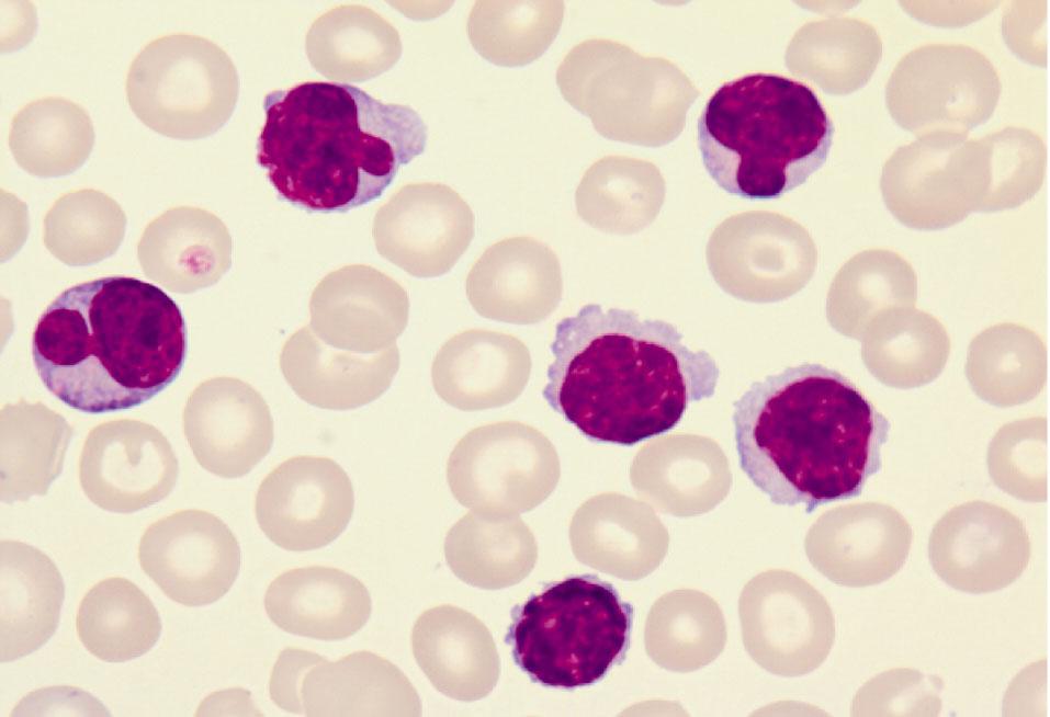 Selected planimetric parameters of B cells for patients with CD38+ and CD38- variant chronic lymphocytic leukemia Ryc. 1.