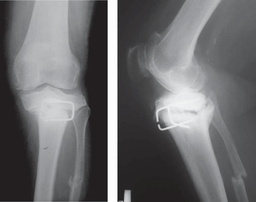 rior stabilization (PS) without tibial stem was implanted. In other patients PFC PS with 60 mm tibial stem was used.