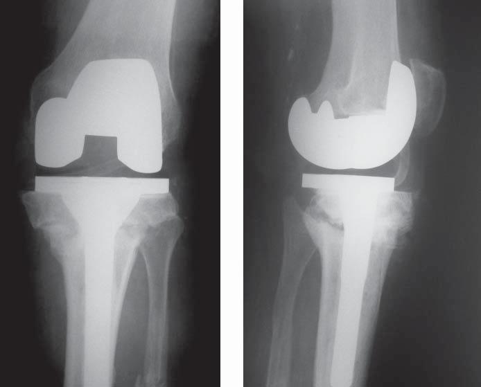 76 J. KOWALCZEWSKI, D. MARCZAK tellar component was used. Haemostasis, drain and sutures ended operative process.