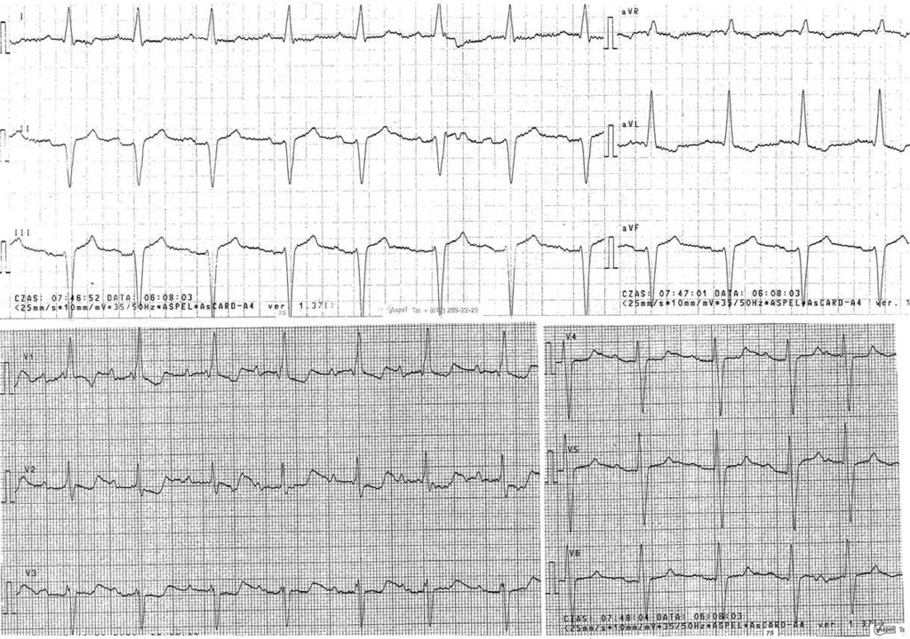 14 M. Maciejewska Rycina 2. EKG pacjenta z NT i blokiem przedniej wiązki lewej odnogi pęczka Hisa. Spełnione kryterium amplitudowe LVH: S w III + RV5 + SV5 > 30 mm. wyższa (ryc. 3).