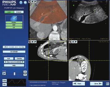 Aparat iu22 wyposażono w zintegrowane funkcje łączenia obrazów oraz nawigacji, które zwiększają pewność diagnostyczną i udostępniają nowe funkcje interwencyjne, poszerzające zakres stosowania