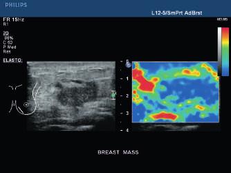 Elastografia nowe narzędzie w obrazowaniu piersi Czy dasz się przekonać, że teraz dostępne są już nowe metody wykrywania zmian w piersiach?