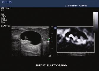 metody umożliwiającej ocenę sztywności tkanki, może zmniejszyć liczbę niepotrzebnych biopsji* To przydatne narzędzie diagnostyczne jest dostępne w przypadku korzystania z ultrasonografu iu22 xmatrix