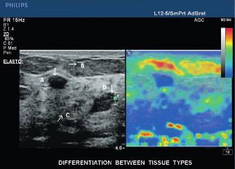 Opracowane przez firmę Philips rozwiązanie elastograficzne tworzy elastogram na podstawie wewnętrznego ruchu struktur anatomicznych pacjenta, a następnie dokonuje pomiaru odległości i obszarów, a