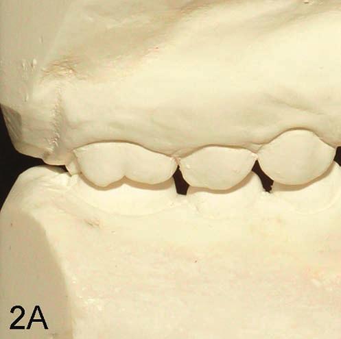 Rycina.2. Wyniki korekty klasy II aparatem Lehmana: A przed; B po leczeniu. Figure 2. Correction of Cl. II by Lehman appliance: A before; B after treatment.