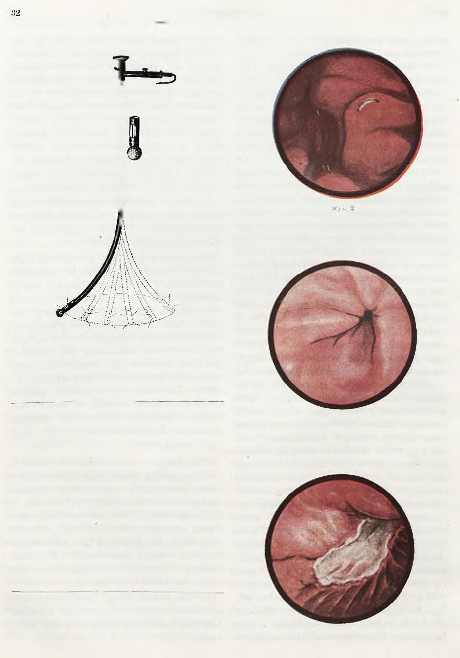 Zaorski: Gastroskopia. Ch. P. Rys. 1.