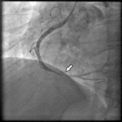 Primary PCI through radial