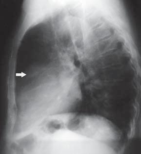 Folia Cardiologica Excerpta 2012, tom 7, nr 2 Rycina 3.