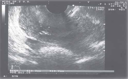 Crown-rump length 9 mm 291 Figure 2. Patient I.