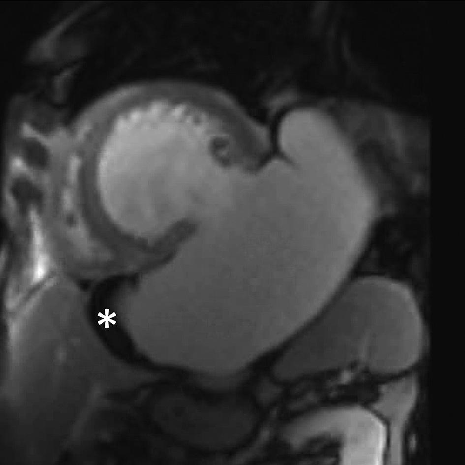 środka kontrastowego uwidoczniono niewielką przyścienną skrzeplinę w segmencie koniuszkowym ściany dolnej (strzałka) Fig. 5. Left ventricular thrombi.