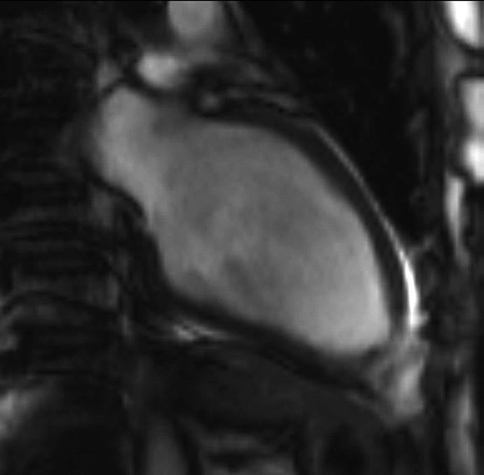Thrombus in the left ventricular apex is seen (arrow); left ventricular pseudoaneurysm partially filled with thrombus (asterix); 2-chamber view before contrast