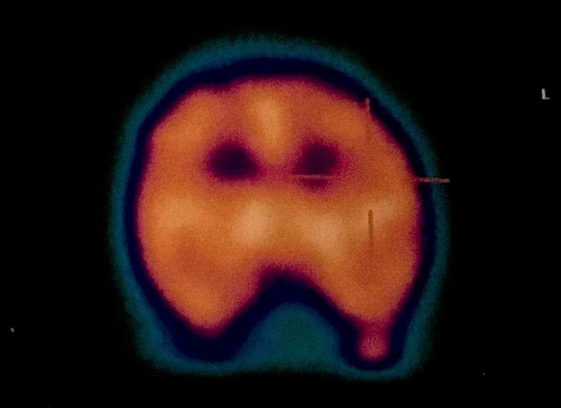 /ml] IgM IgG 5,5 (N < 4,5) 7,6 (N < 9,5) 13,8 (N < 20,0) 33,5 (N < 10,0) 7,67 (N < 20,0) 7,75 (N < 10,0) - Przeciwciała przeciwko beta-2-glikoproteinie I [j.