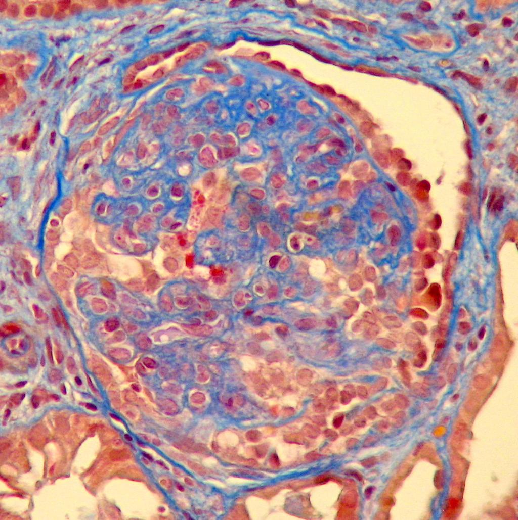 zwiększenie liczby oraz powiększenie (hypertrofia) podocytów, tip lesion: we wszystkich zajętych kłębuszkach zrost pętli naczyniowej z torebką Bowmana widoczny jest w obszarze ujścia cewki