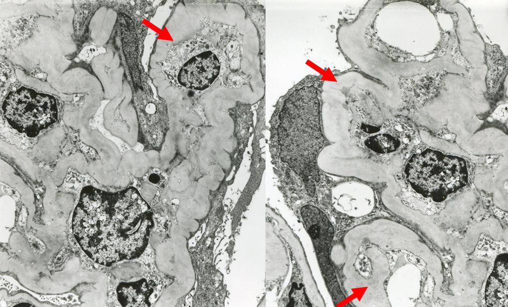 Sclerotic segment forms extensive adhesion with Bowman s capsule (arrows). AFOG staining. Rycina 7 Ogniskowe segmentalne twardnienie kłębuszków.