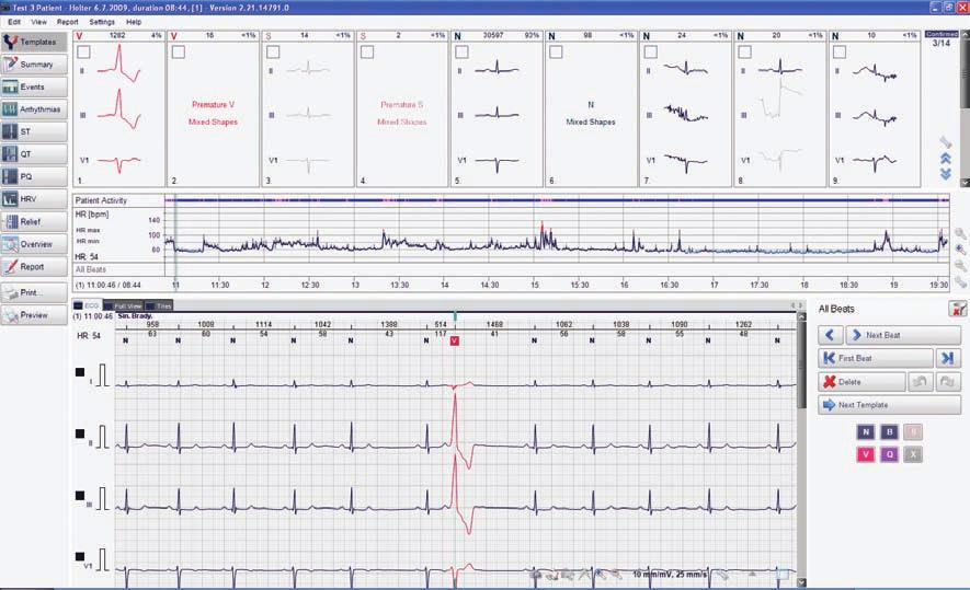 20 HOLtEr BTL CardioPoint-Holter EKrAN KLASYFiKACji 3, 7, 12-KANAŁOWy MONitOriNG PACJENtA do 7 dni rejestracja 12-kanałowa umożliwia uzyskanie najbardziej wyczerpujących informacji i daje możliwość