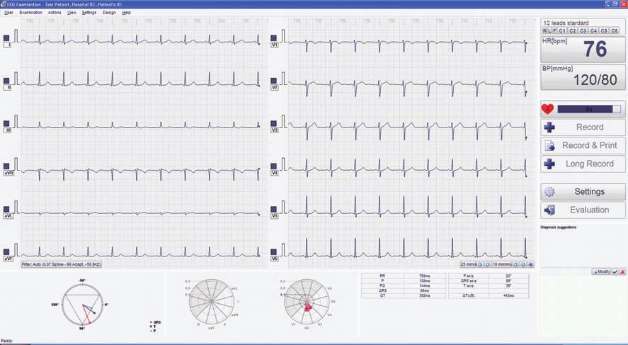 PrOFEsJONALNE i szybkie EKG Zapis 12-kanałów EKG tryb szybkiego EKG długotrwałe monitorowanie EKG tryb LONG Edycja raportów Automatyczna interpretacja tekstowa Zaawansowane narzędzia diagnostyczne