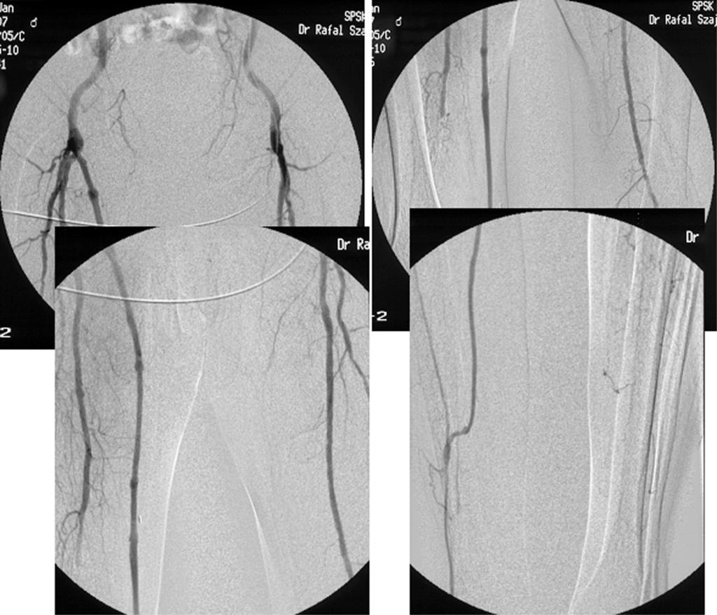 Acta Angiol., 2006, Vol. 12, No. 1 Figure 5. Postoperative arteriography. Femoro-anterior tibial bypass graft in patient with ischemic diabetic foot Rycina 5. Arteriografia pooperacyjna.