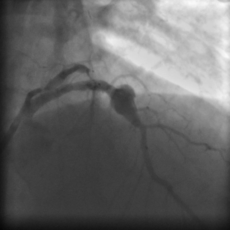 Fig. 2. Positioning of the classic bare metal stent inside the aneurysm Ryc. 2. Pozycjonowanie klasycznego stentu meta - lowego w obrębie tętniaka Fig.