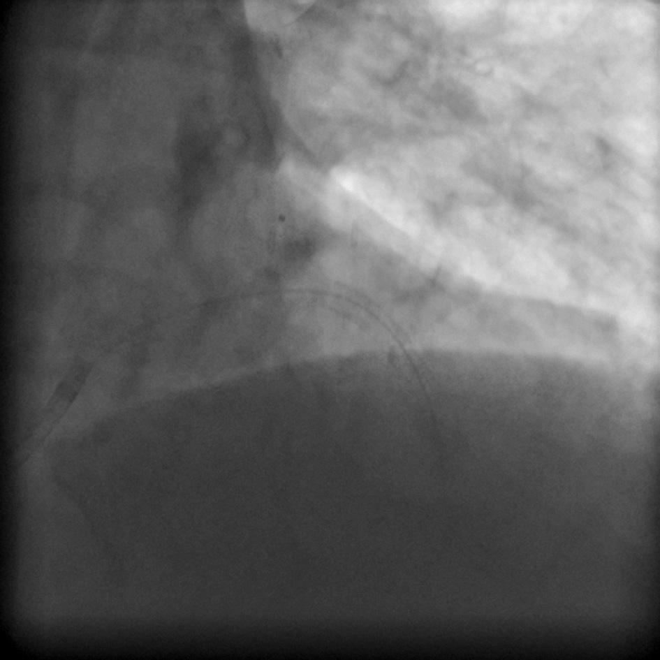 5. First stent graft after implantation Ryc. 5.