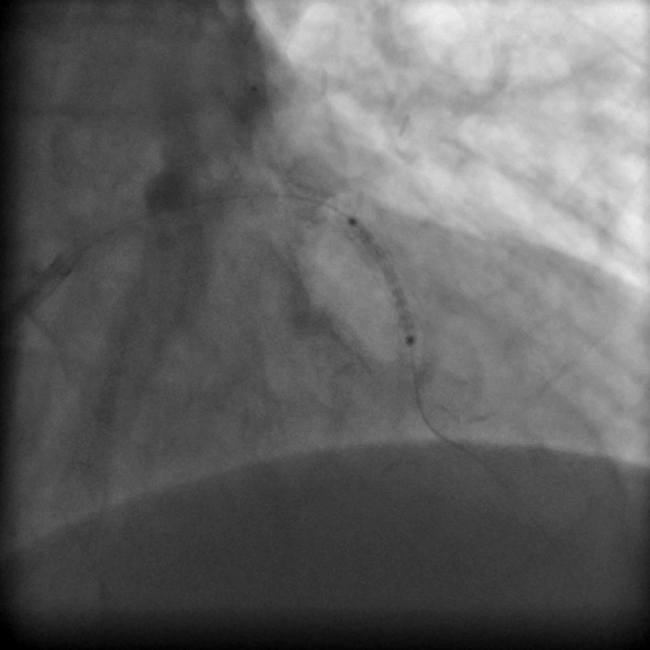 inferoseptal akinesis with left ventricular ejection fraction (LVEF) 45%.