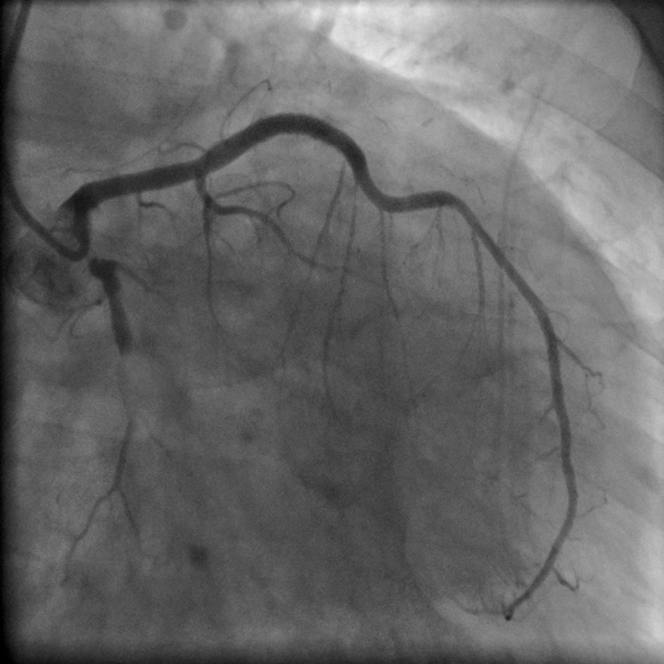 dobie pobytu Discussion The patient s age and history indicate atherosclerosis as the most likely cause of CAA.