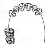 określa cechy pełnego uzębienia stałego: triady zębowe, punkty styczne; rozróżnia wg. wskazanej klasyfikacji braki uzębienia, np.
