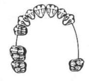 Który schemat przedstawia braki zębowe zaliczane w klasyfikacji Kenedy ego do klasy II? A. B. C. D. Odpowiedź prawidłowa: B.