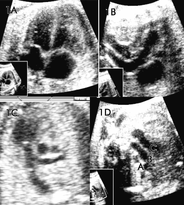 Ginekol Pol. 2009, 80, 466-470 I N F O R M A C J A S odki M, et al. Prawid owy obraz LVOT charakteryzuje si ciàg oêcià mi dzy przednià Êcianà aorty i przegrody mi dzykomorowej. (Rycina 1B).