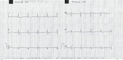 Folia Cardiologica Excerpta 2012, tom 7, nr 1 Rycina 1. Rytm zatokowy o częstości 71/min, oś pośrednia, cechy przerostu i przeciążenia lewej komory.