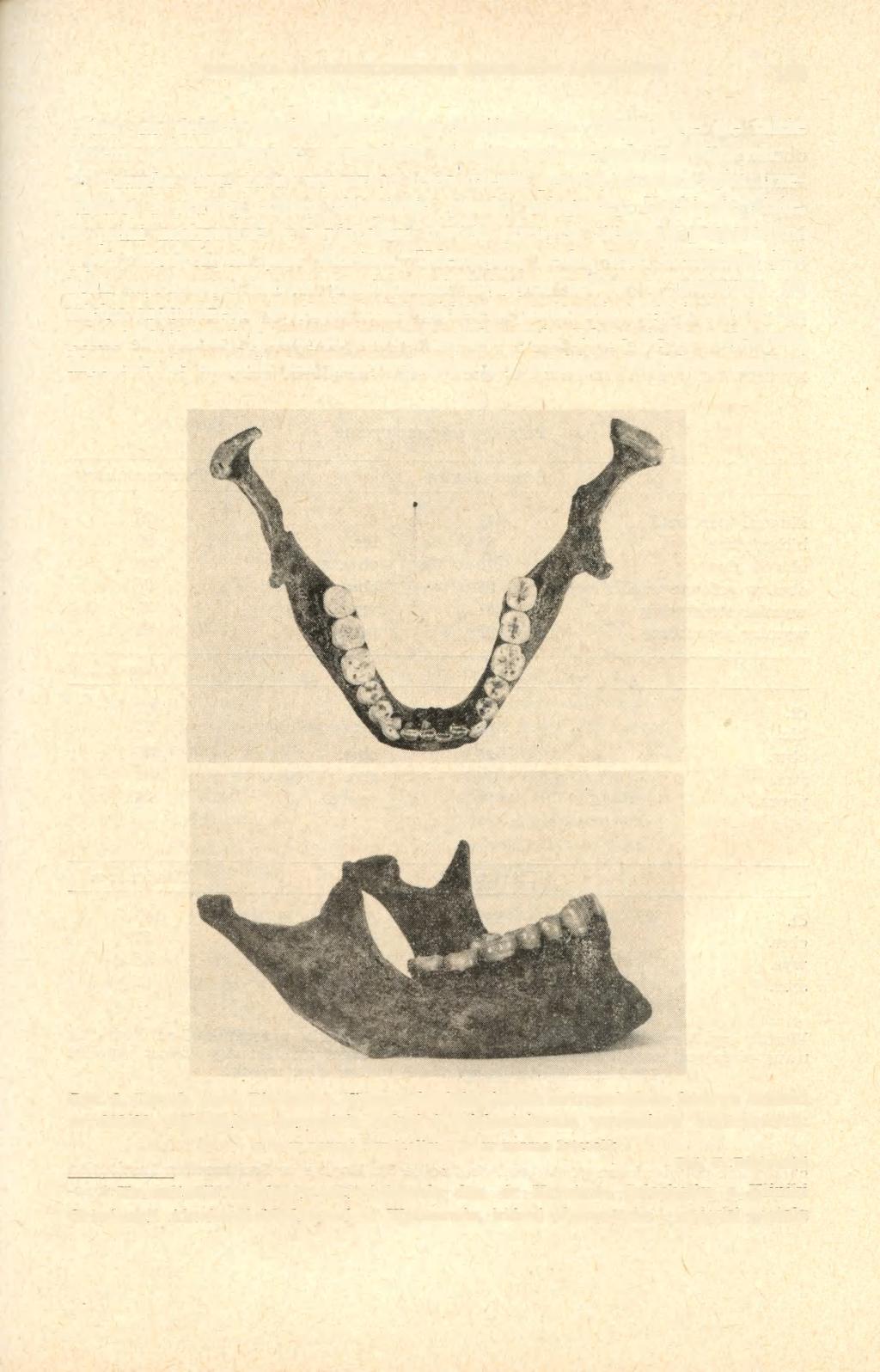 ANALIZA ANTROPOLOGICZNA SZKIELETU LUDZKIEGO 163 culae) na dolnej powierzchni końca łopatkowego. Obserwuje się także zmiany osteoporotyczne, szczególnie widoczne na kręgach lędźwiowych.
