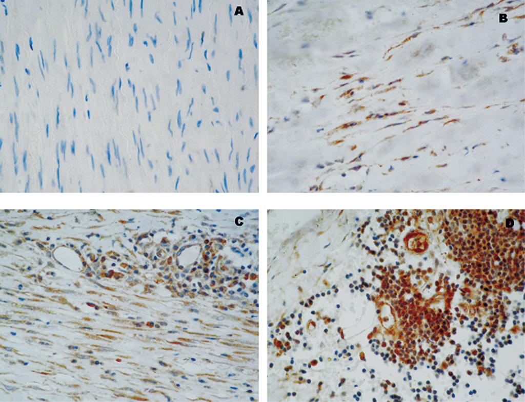 Acta Angiol., 2006, Vol. 12, No. 1 A B C D Figure 3. A. Negative immunoreactivity for VEGF in normal aorta control); B. Focal positive immunoreactivity in aortoliac occlusion; C.