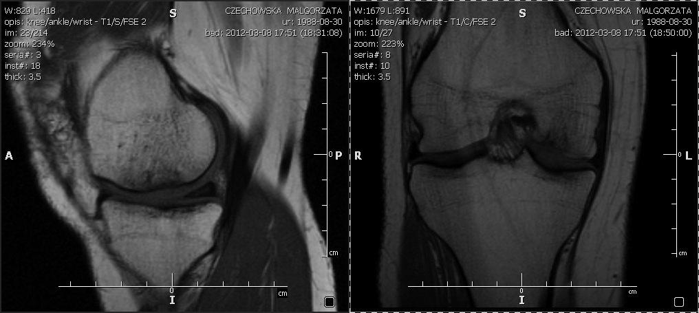 kowym MR po roku od zabiegu Fig. 4. 23-y.o. women with MFC lesion MRI one year post surgery 4 osteotomie walgizujące i 3 naprawy więzadła krzyżowego przedniego oraz w 2 przypadkach wykonano szew